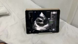 โพรบอัลตราซาวนด์ไร้สายแบบหัวคู่สำหรับหัวใจและ POCUS